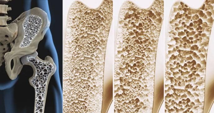 Cómo manejar la Osteoporosis: Estrategias prácticas para la salud ósea a partir de los 50 Años
